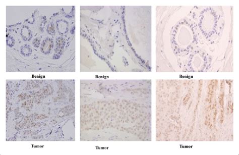Staining Of Matched Pairs Of Benign And Tumor Tissue Samples From