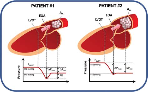 The Phenomenon Of Pressure Recovery In Aortic Stenosis Schematic