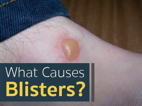 Blisters Causes Symptoms Treatment And Prevention