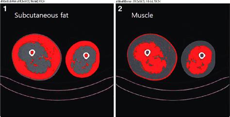 Measuring Subcutaneous Fat And Muscle Using Mid Thigh Computed