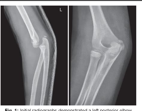 Figure 2 From Incarcerated Coronoid Fracture At The Time Of Pediatric