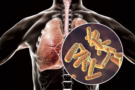 Klebsiella Pneumoniae Menyebabkan Penyakit Homecare24