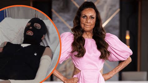 If You Dont Feel Better By Then Just End It Turia Pitt Talks About Her Incredible Recovery