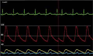 Sweep Chart Problems In Patient Monitor Labview General Lava