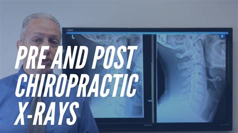 Pre And Post X Rays Show Improvement With Chiropractic Care Houston