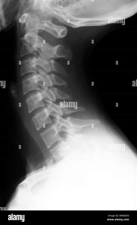 Cervical Spine X Ray Cervical Spine X Ray Cervical Spine Left