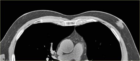 The Radiology Assistant Pathology Of The Male Breast