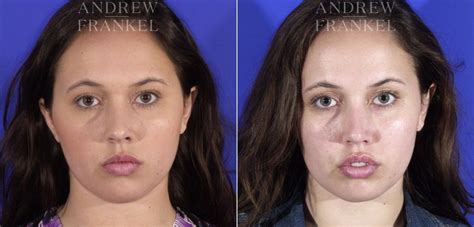 Buccal Fat Removal Before And After Photos Andrew S Frankel Md