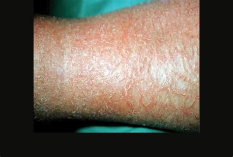 The Many Manifestations Of Eczema
