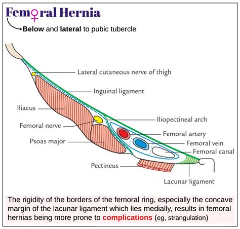 Diagram Diagram Of Femoral Hernia Mydiagram Online