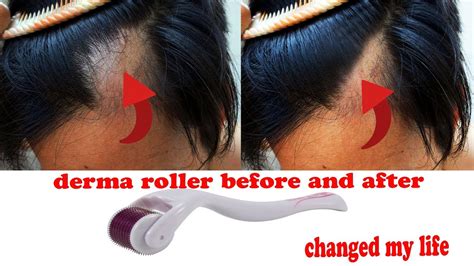derma roller hair regrowth how to use derma roller for hair growth youtube