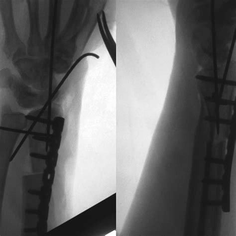 Intraoperative Fluoroscopy Images Anteroposterior And Lateral Views