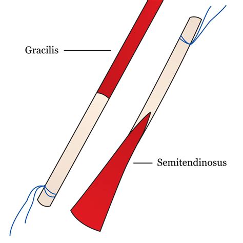 Identification Of The Gracilis And Semitendinosus Tendon According To