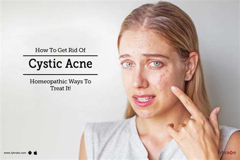 How To Get Rid Of Cystic Acne Homeopathic Ways To Treat It By Dr