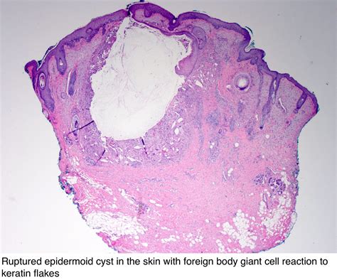 Pathology Outlines Epidermal Epidermoid Type Free Hot Nude Porn Pic