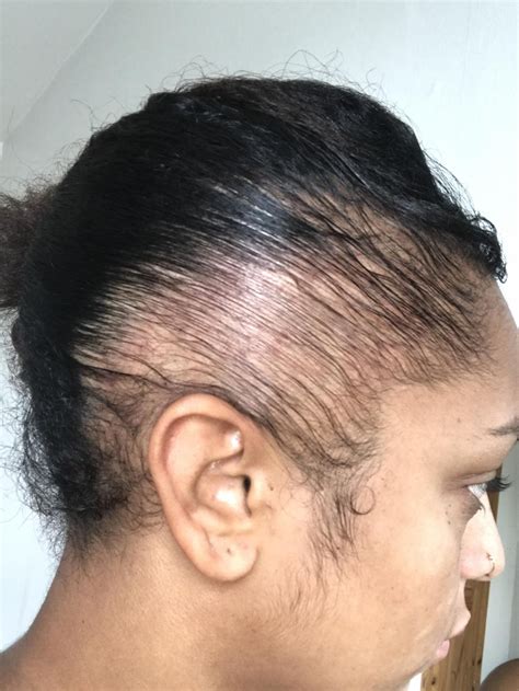 Https://tommynaija.com/hairstyle/alopecia Hairstyle Specialist In Indianapolis