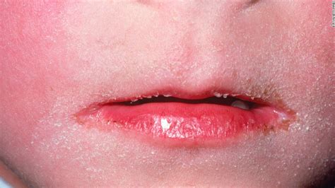 6 Info How To Treat Scarlet Fever Rash Corona Virus Corona