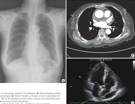 Figure 1 From A Case Report Of Primary Pericardial Malignant