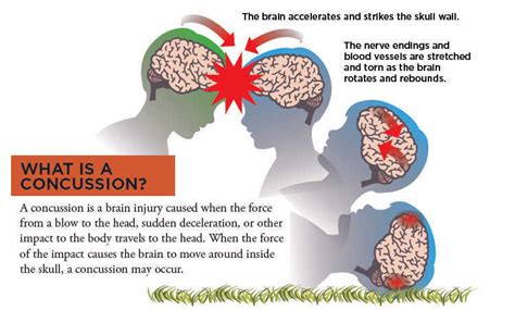 The symptoms of concussion (mild traumatic brain injury) include headache, nausea, irritability, poor concentration, and emotional changes. Concussion Guide | UCSF Benioff Children's Hospital Oakland