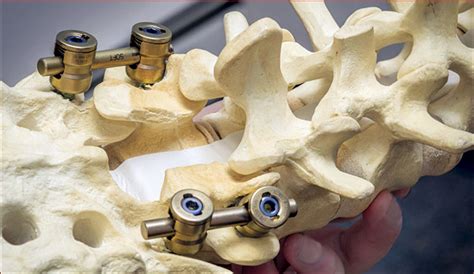 Spinal Surgery Shouldnt Bar Access To Spinraza Polish Sma Expert Says