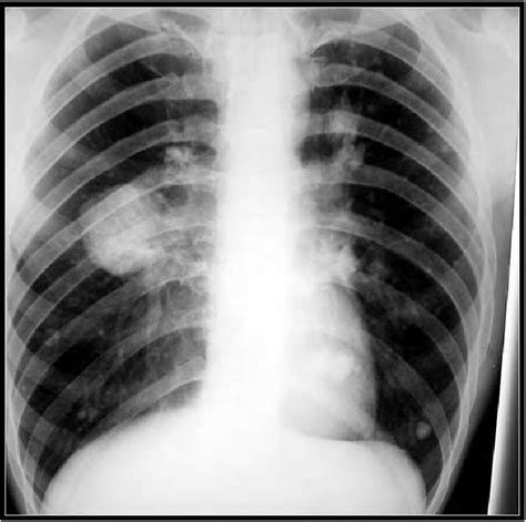 A Chest Radiograph Of The Patient From Figure 18 Showing Calcified