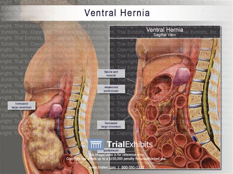 Ventral Hernia Sagittal View Trialexhibits Inc
