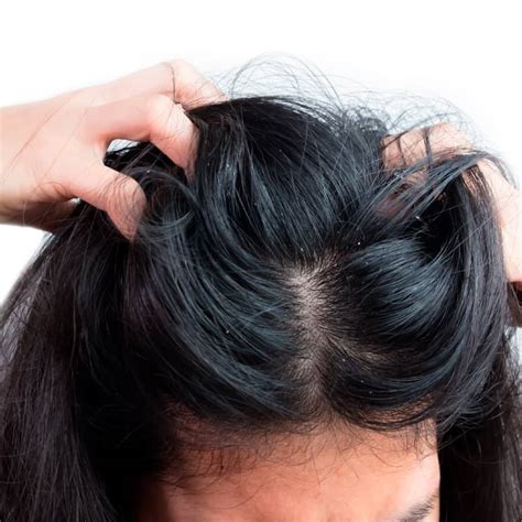 How to Get Rid of Dandruff? - Dr. Praneeth Skin Hair Laser Clinic