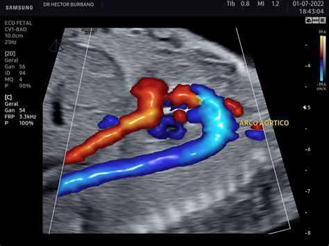 Placenta Grau 0 No Segundo Trimestre
