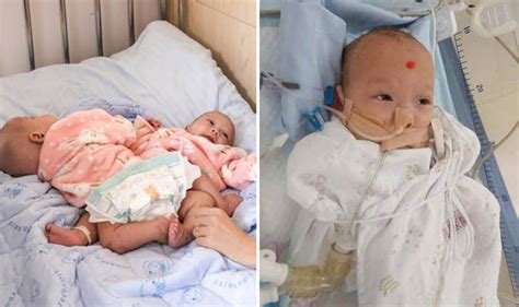 Conjoined Twins In China Separated After 12 Hour Operation Using 3d