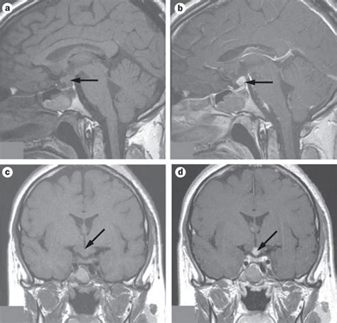 mri scan of the pituitary of the case patient the mri scan shows a download scientific diagram