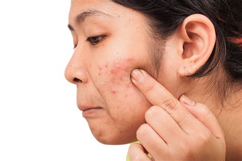 Difference Between Pimples Fever Blisters Healthfully