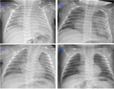 Chest X Rays Image A On Day Of Admission Showing Hazy Bilateral
