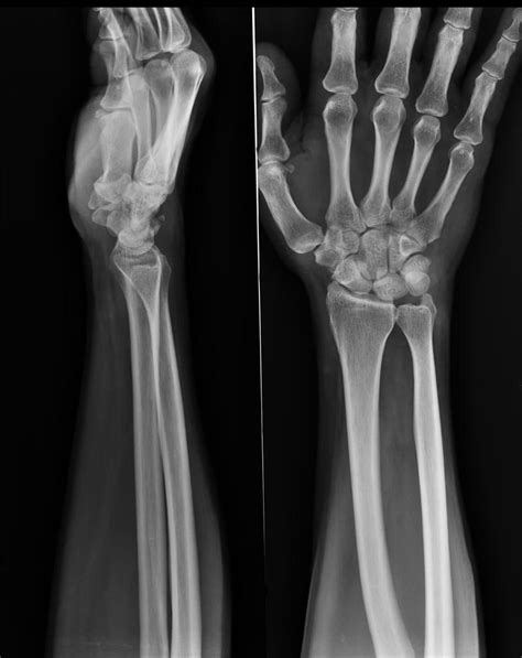 Triquetral Fracture Radiology Case Radiology