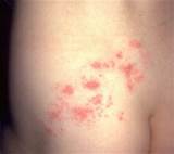 How To Manage Herpes Outbreak Images