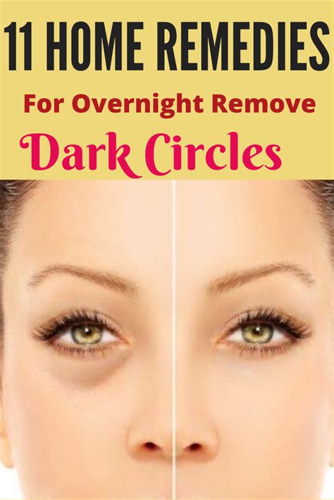 How To Get Rid Of Dark Circles At Home Overnight Trabeauli Remove
