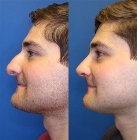 Nose Surgery Before And After Photos Patient 224 San Francisco Ca