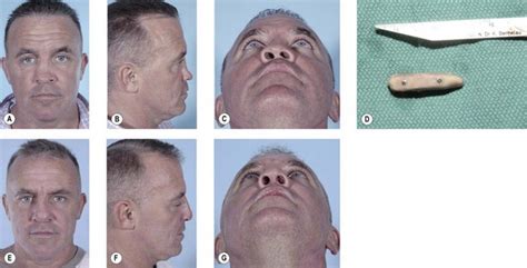 Acquired Cranial And Facial Bone Deformities Plastic Surgery Key