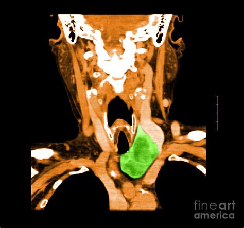 Ct Of Neck Showing Thyroid Goiter Photograph By Medical Body Scans