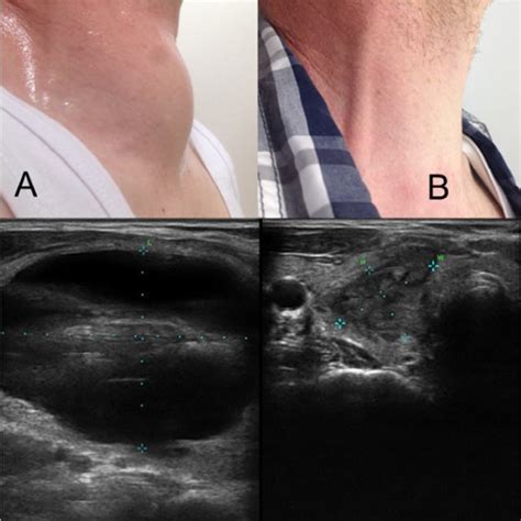 Radiofrequency Ablation Rfa Of Thyroid Cyst Thyroid Cysts With
