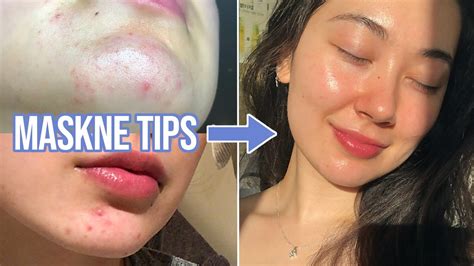Maskne Tips 😷 How To Prevent And Treat Mask Acne Youtube