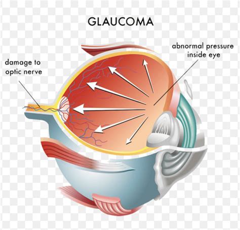Glaucoma Gupta Eye Hospital