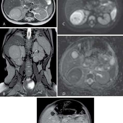 Wilms Tumor In A 5 Year Old Baby Boy Axial Contrast Enhanced Ct Images