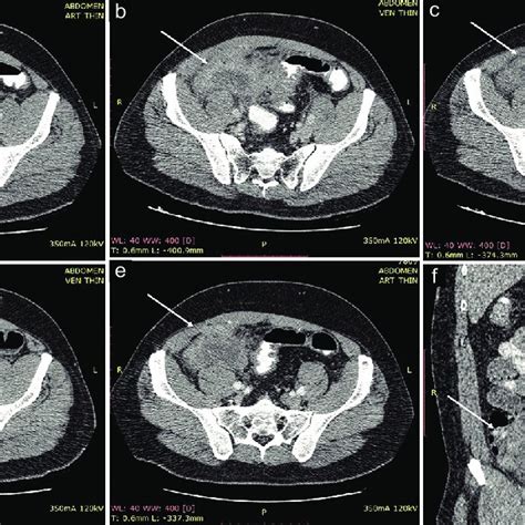 Serial Contrast Enhanced Computed Tomography Cect Scans First Scan