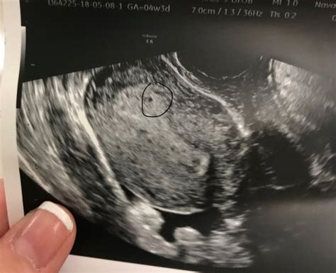 4 Weeks 3 Days Ultrasound Hiccups Pregnancy