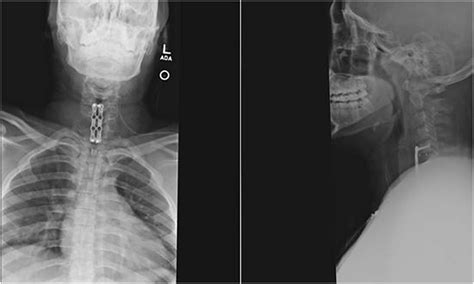 Post Operative X Rays Of The Cervical Spine Download Scientific Diagram