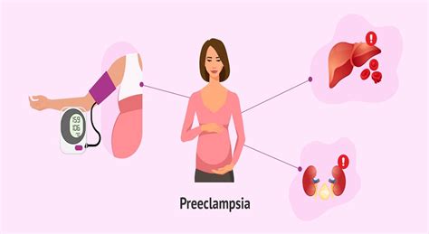 Preeclampsia Vector Illustration Labeled Pregnancy Complication Scheme Stock Illustration