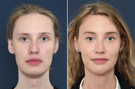 Facial Feminization Surgery Tracheal Shave De Adamsappel Reduceren