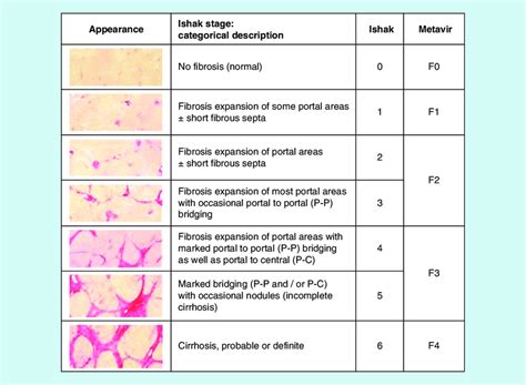 Grading And Staging Of The Histopathological Lesion Of Liver Biopsy My XXX Hot Girl