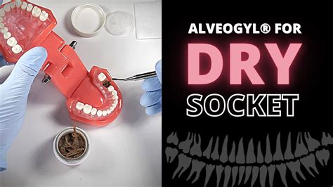 Using Alveogyl To Relieve Dry Socket Pain Alveolar Osteitis