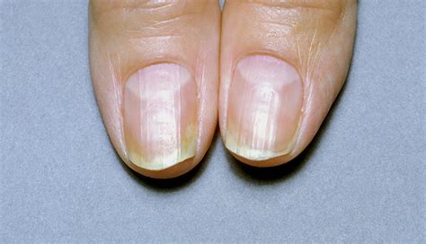 What Are Your Nails Saying About Your Health